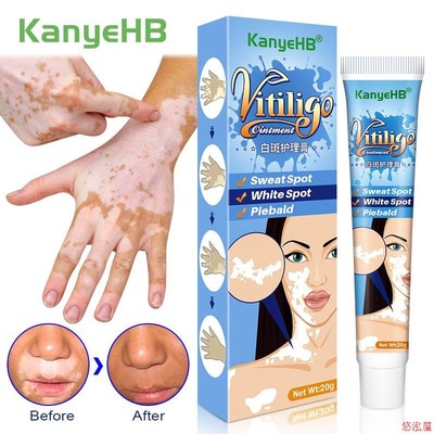 20g Herbal Extract Vitiligo Ointment Remove Ringworm White S
