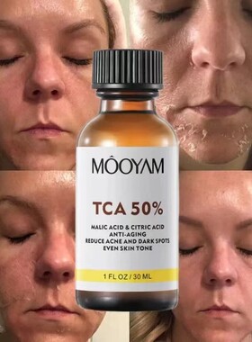 TCA 50% Chemical Peel Tca Peel Acid Skin Superforce Peel