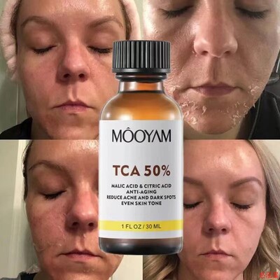TCA 50% Chemical Peel Tca Peel Acid Skin Superforce Peel