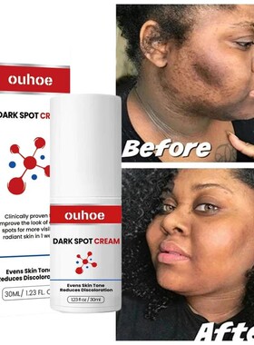 Dark Spot Remover Cream Whitening Body Lotion Lighten Melani