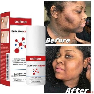 Dark Spot Remover Cream Whitening Body Lotion Lighten Melani