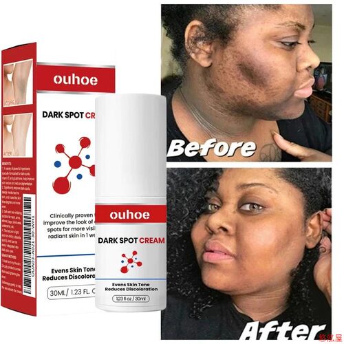 Dark Spot Remover Cream Whitening Body Lotion Lighten Melani