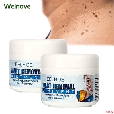 30g Skin Tag Remover Cream Warts Mole Remove Ointment Antiba