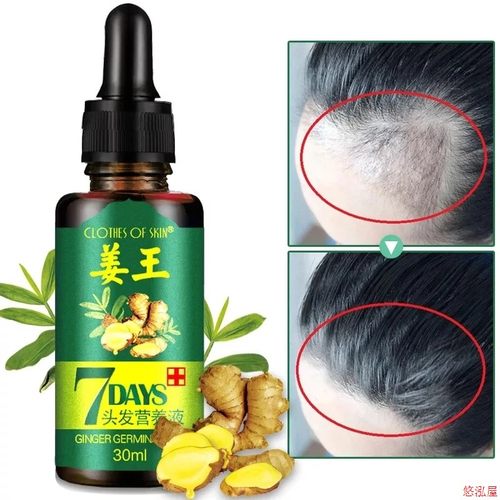 Hair Loss Treatment Ginger Growth Essence Oil老姜头发养护油