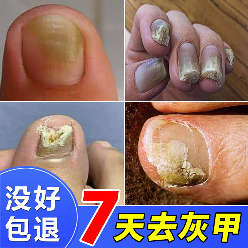 手脚趾甲床分离空甲软化剂抑菌液修复水脱灰甲膏坏指甲康变好神器