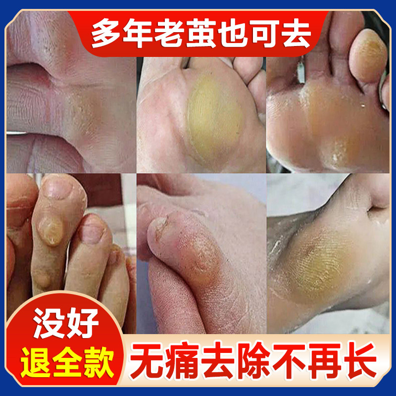 老茧去除软化剂去脚底脚垫厚茧子根祛鸡眼脚钉膏小脚趾关节茧立净