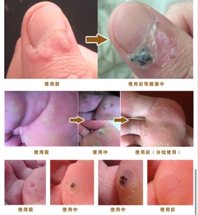 【店内销售】肉刺猴子 zhiyou血泡刺皮肤黑点去除  买二送一