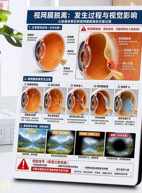 视网膜脱离发生过程科普相框摆台眼科医院眼底病急症护眼装饰摆件