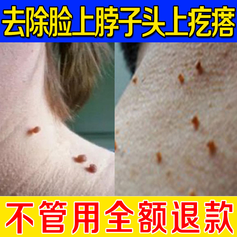 佰草立净去脖子上长的小肉粒疙瘩腋下头上长丑肉皮赘肉痣去除膏