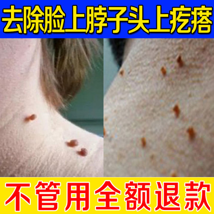 佰草立净去脖子上长的小肉粒疙瘩腋下头上长丑肉皮赘肉痣去除膏