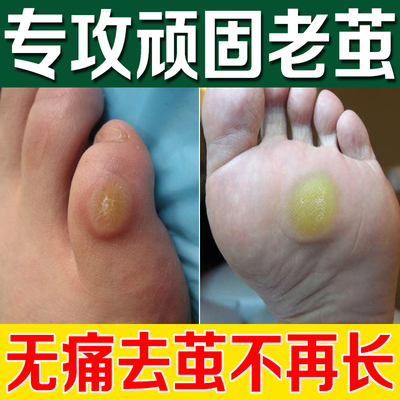 佰草钟医无痛去除老茧脚茧关节茧