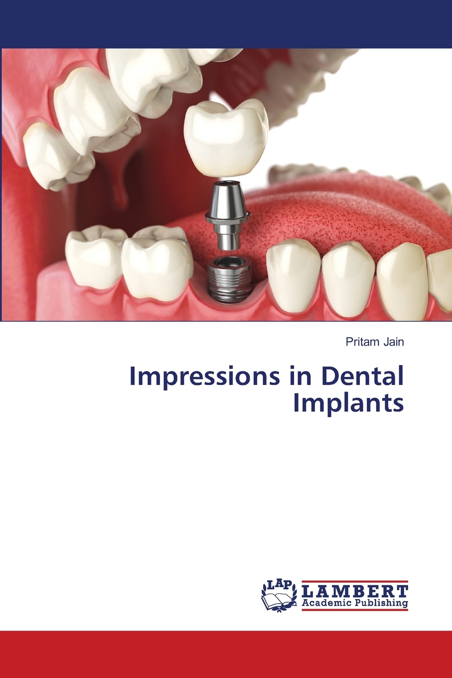 预售按需印刷 Impressions in Dental Implants