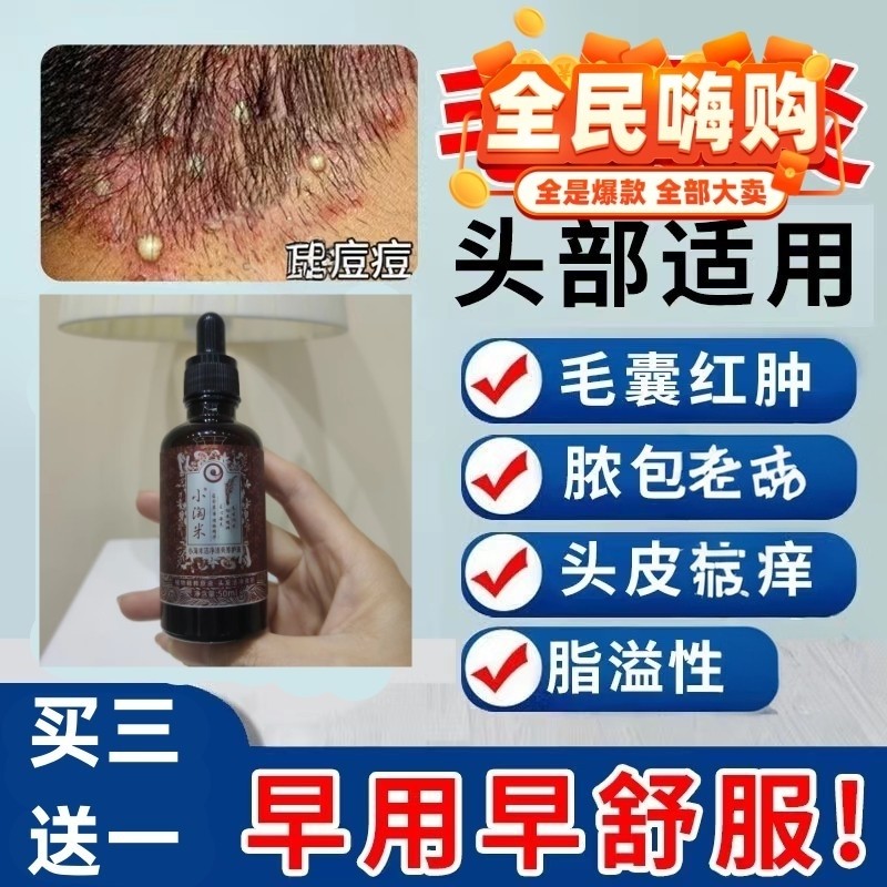 淘米水洗发水毛馕头皮专用药水头部全身溢脂软膏红炎长痘痘去屑止