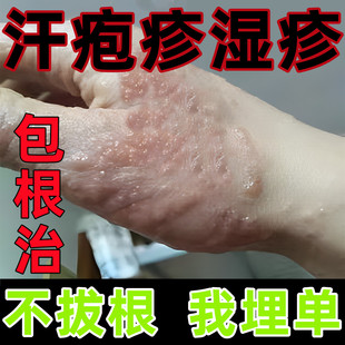 汗泡疱疹汉状真菌感染手气膏手上起小水泡专用药膏鹅掌风特效克星