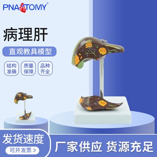 仿真医学病理肝脏解剖模型抽烟肝消化科教学标本肝胆教具可拆卸