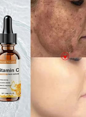 Vitamin C Whitening Serum Remove Freckles Dark Spots Face Es