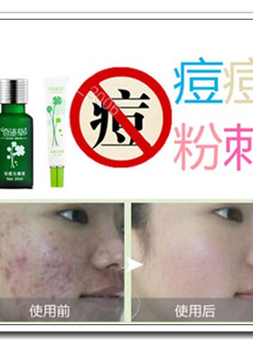 进口祛背部痤疮正品消除背上粉刺螨虫背后痘痘立消膏去掉暗疮痘印