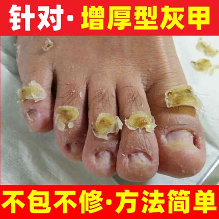 灰指甲药水特效专用凤仙花抑菌液软甲日本脱甲膏修甲刀进口药正品