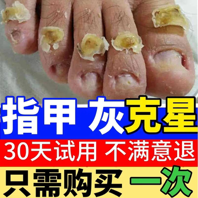 灰指甲药水特效专用凤仙花抑菌液软甲日本脱甲膏修甲刀正品BB