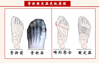 新品脚趾头骨折固定夹板大脚拇指趾骨折夹板护具骨折外翻防护固定