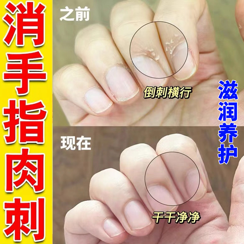 手指倒刺成人儿童护理去手上长刺干裂脱皮神器指甲边缘手足脱皮膏