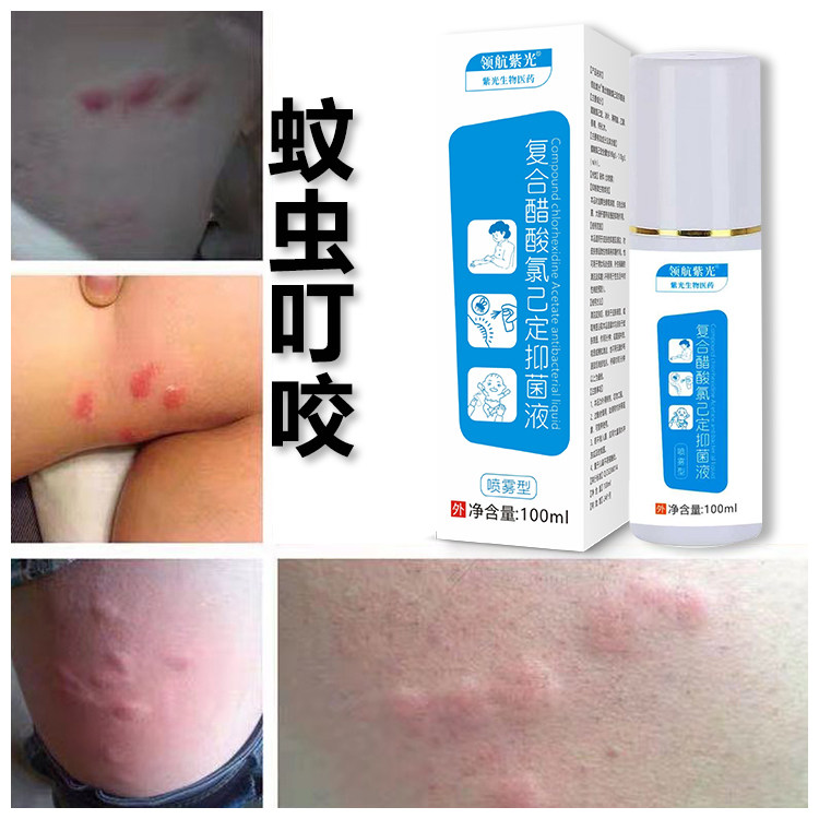 蚊虫叮咬起红疙瘩皮肤瘙痒儿童止痒喷剂跳蚤臭虫叮咬宝宝快速止痒