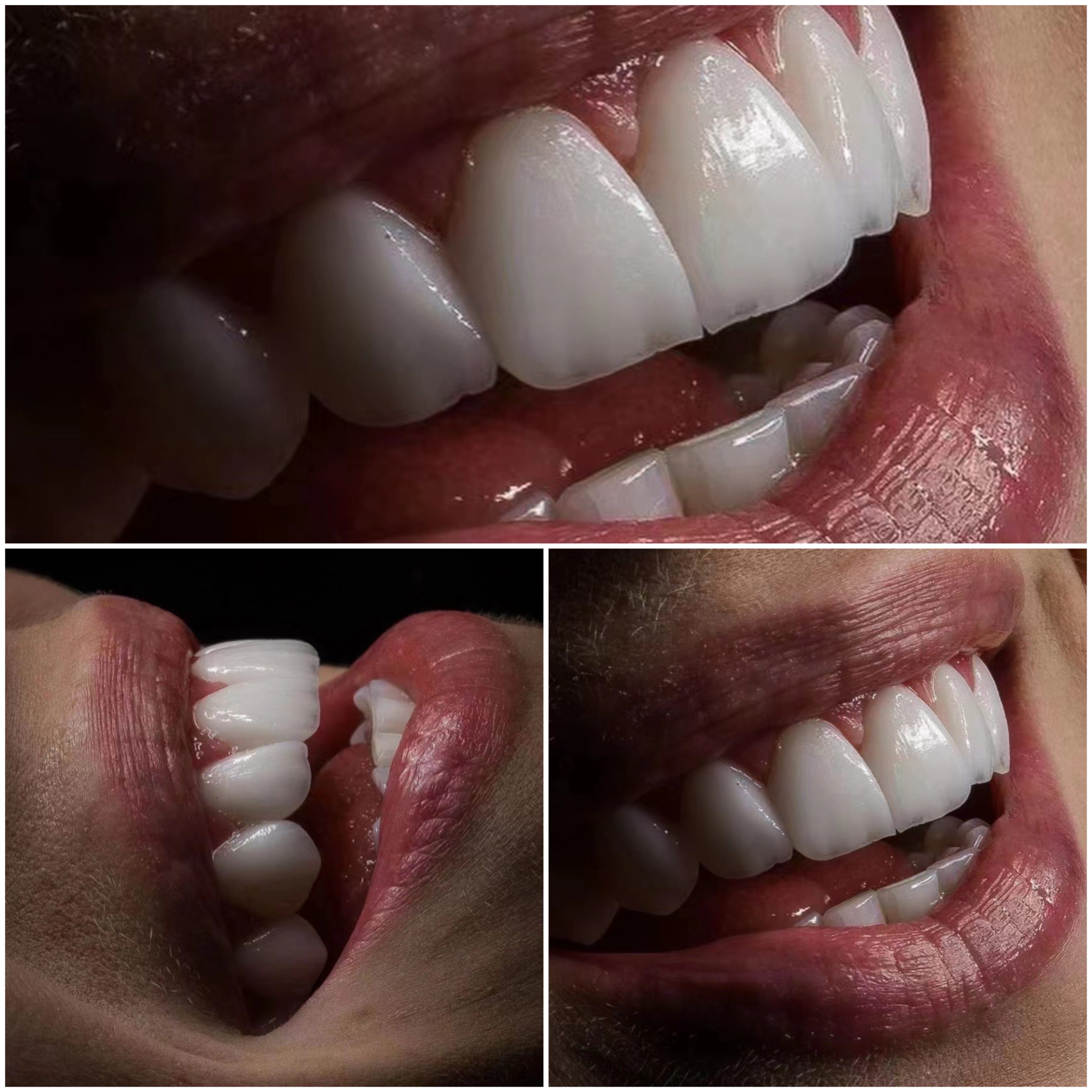 正品义获嘉全瓷贴面 牙齿贴片陶瓷烤瓷vita牙齿贴面修复牙缝牙冠