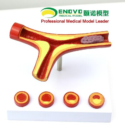 ENOVO颐诺冠状动脉性心血管模型