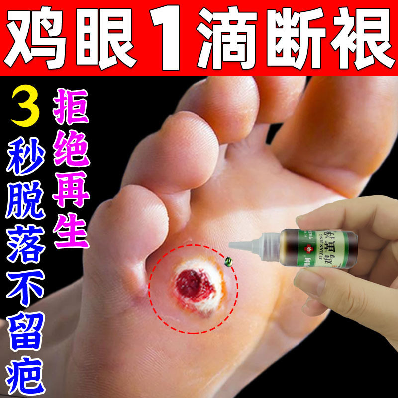 得了鸡眼怎么办脚上长硬疙瘩肉刺跖疣专用膏祛根水老茧鸡贴眼液