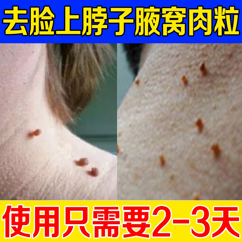 扁平疣去除膏一抹灵去疣瘊小肉粒神器去疣非药去脖子上长丝状跖疣