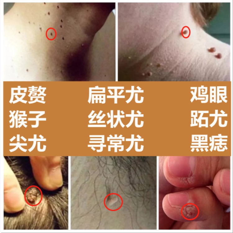 脖子上小肉球肉粒肉刺疙瘩赘肉丝状疣瘊子去除神器腋下疣一抹无忧