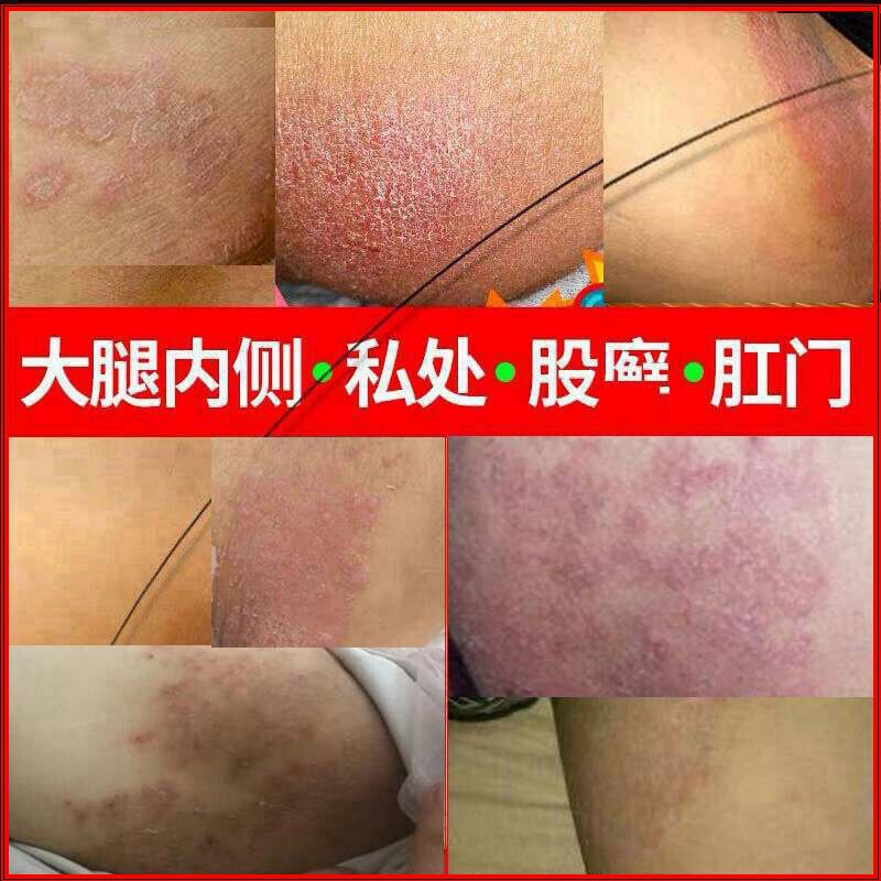 私痒净肛门肛周专用阴囊药去大腿根湿痒内侧股沟胯下屁股癣疹膏身
