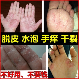 治皮肤手痒脱皮水泡烂手掌心水泥过敏脚指头瘙痒干裂藓气药止痒膏