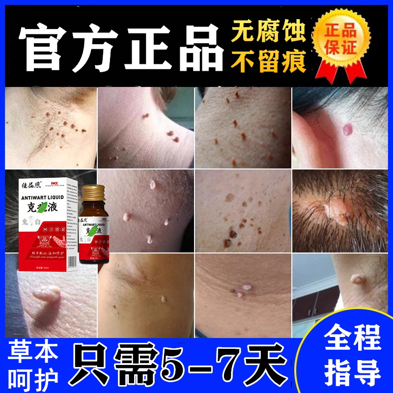 正品鬼臼足叶毒素酊鬼舀霉素汀私处立净软膏溶液剂乳膏竹叶草脂
