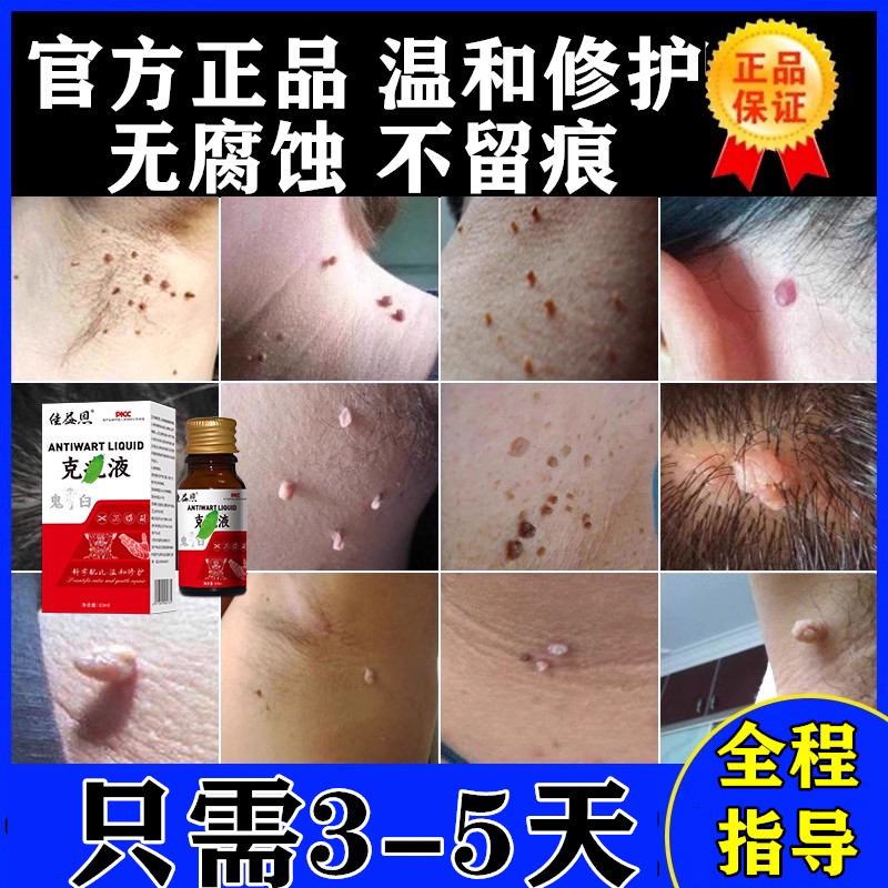 鬼臼毒素酊剂足叶草脂鬼舀霉素竹叶草脂乳膏溶液