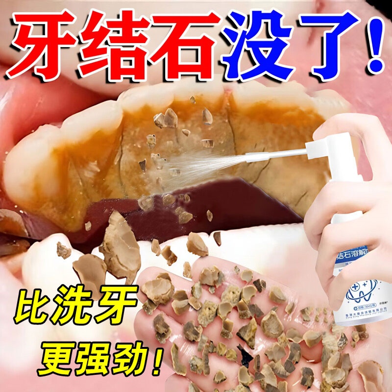 【去牙结石牙渍】牙结石溶解喷雾