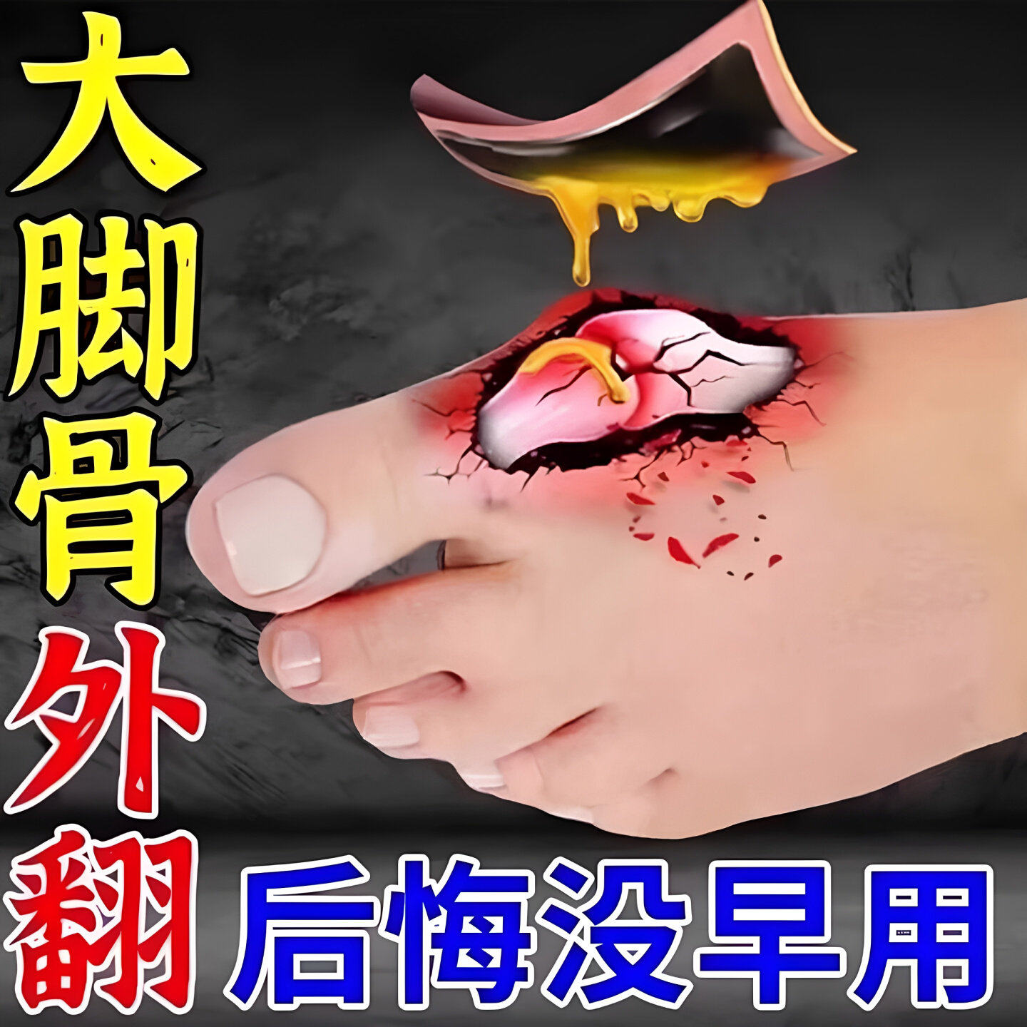 拇指药膏贴专用外翻大脚趾骨外翻炎突出矫正器拇囊关节防磨疼痛膏