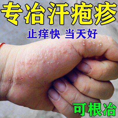 【手上小水泡】汗疱疹专用抑菌膏
