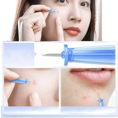 BlackheadRemoverAcnNT