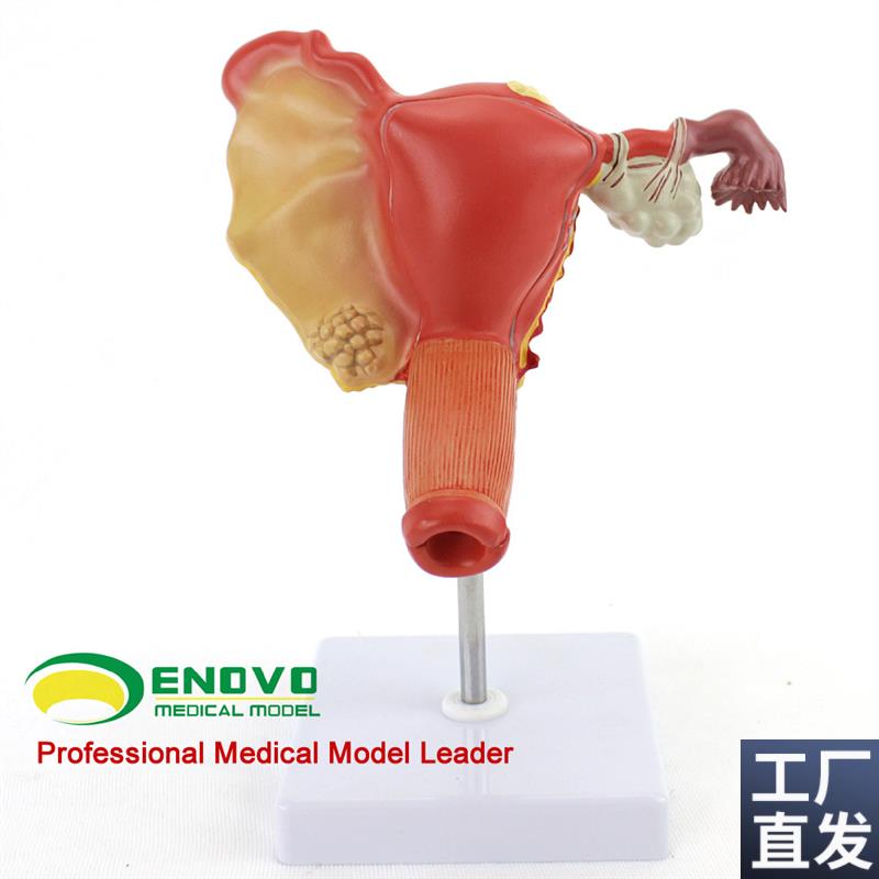 ENOVOd颐诺人体子宫卵巢阴道疾病模型女性内外生殖科妇产科医学用