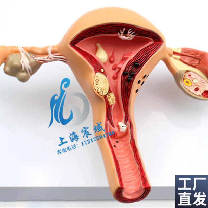 子宫卵巢病理病变模型生殖科女性内外生殖器官X模具教学病变