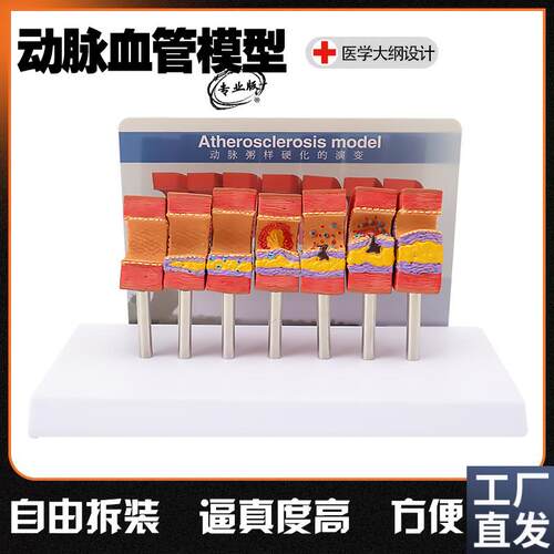 人体血管病理解剖模型人体血管结A构模型血液浓度脂肪病理血管粥
