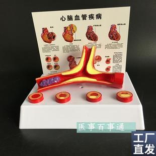 血管模型冠状动脉性心脏病动脉化模型老年科R医患沟通演示模型