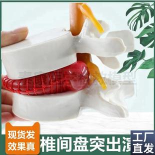 椎间盘压迫神经演示模型突出脊骨劳损骨质密度变T化疏松变脆老年