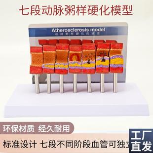 动脉粥样硬化模型血管血栓栓塞模型动脉血管人体R医用医学教学模