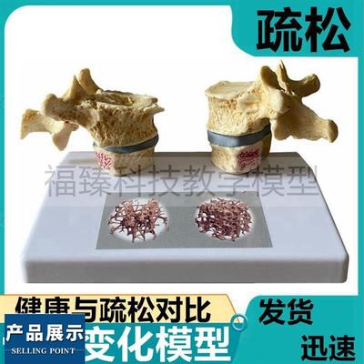 病理骨质模型疏松密质松质人体脊椎骨变形老年人骨骼变脆医药礼品
