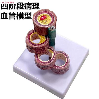 硬化支脉粥样血管模型心血管动脉解剖模型人体病R态血管模型血栓