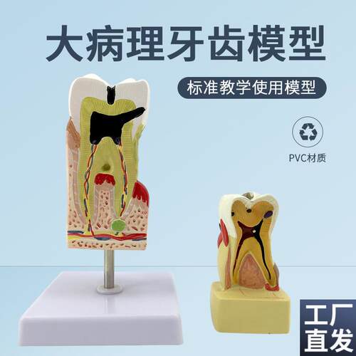 人体病态蛀牙模牙齿牙结w构解剖蛀牙模型牙齿病综合病理模型