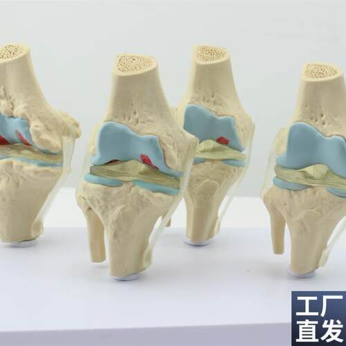 ENOVO颐诺人体病理膝关节模型退行性血友病模型S骨科管骨骼模型膝
