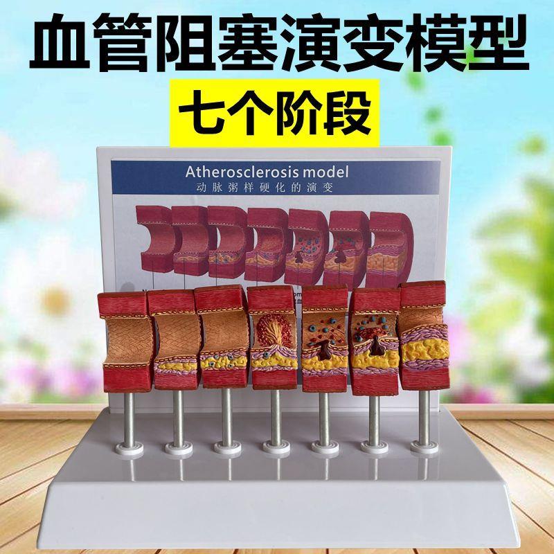 动脉血管模型走样硬化演变脂肪管腔狭窄中老年血管医患沟通医药礼